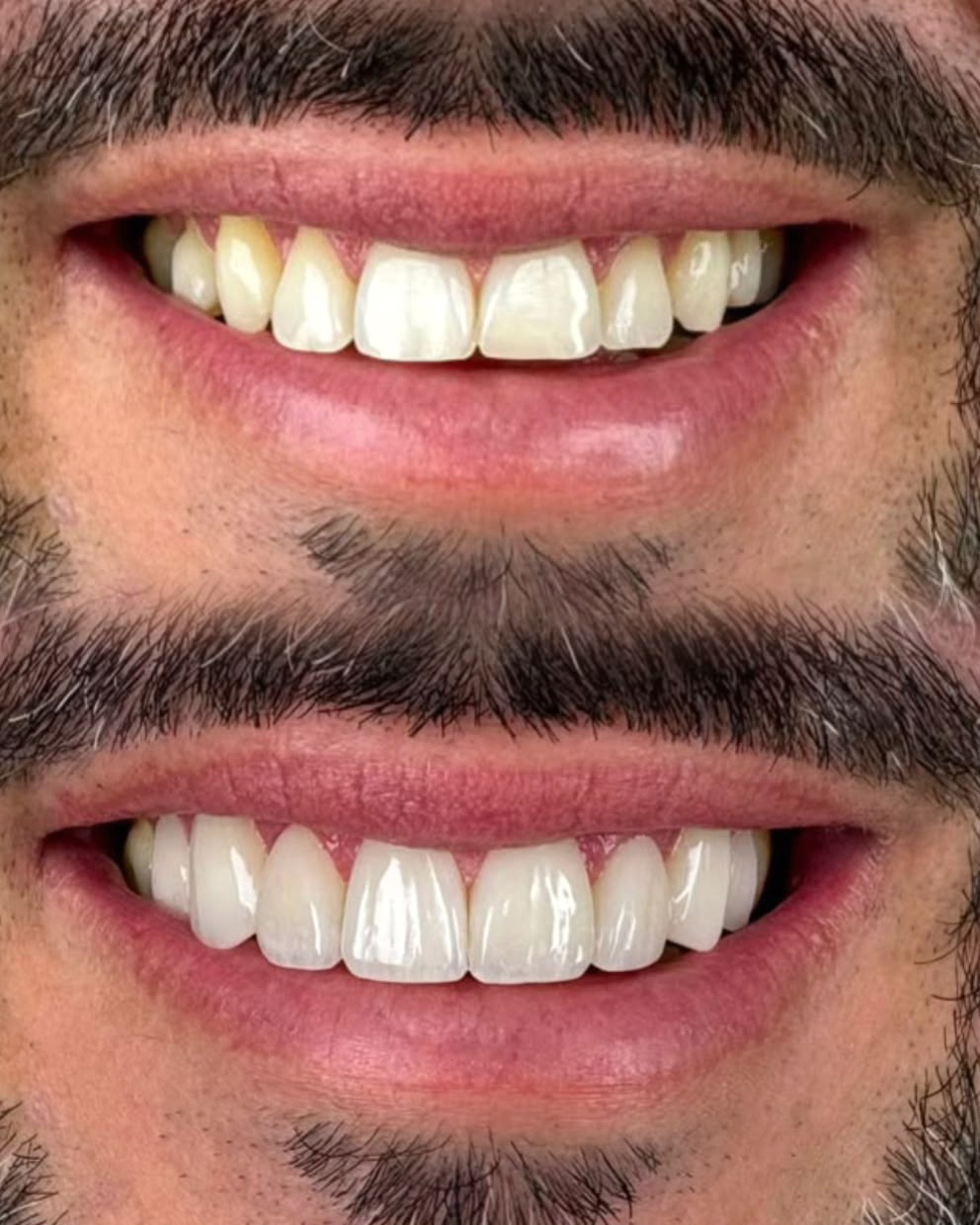 Antes e depois de caso clínico real realizado pelo Dr. Marcone Monteiro, com foco em naturalidade