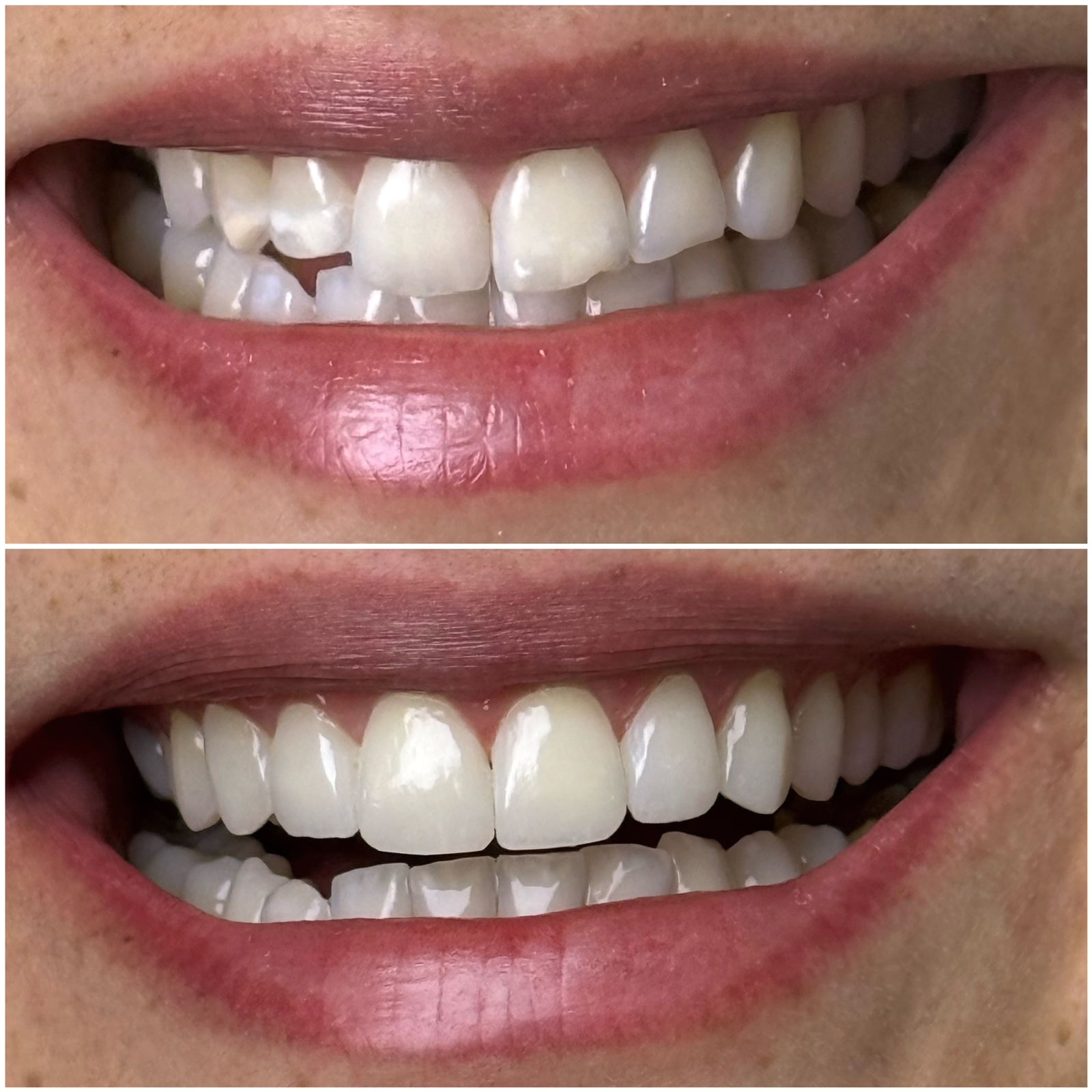 Antes e depois de caso clínico real realizado pelo Dr. Marcone Monteiro